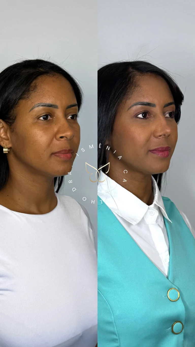 Antes e depois de Rino Sculpt