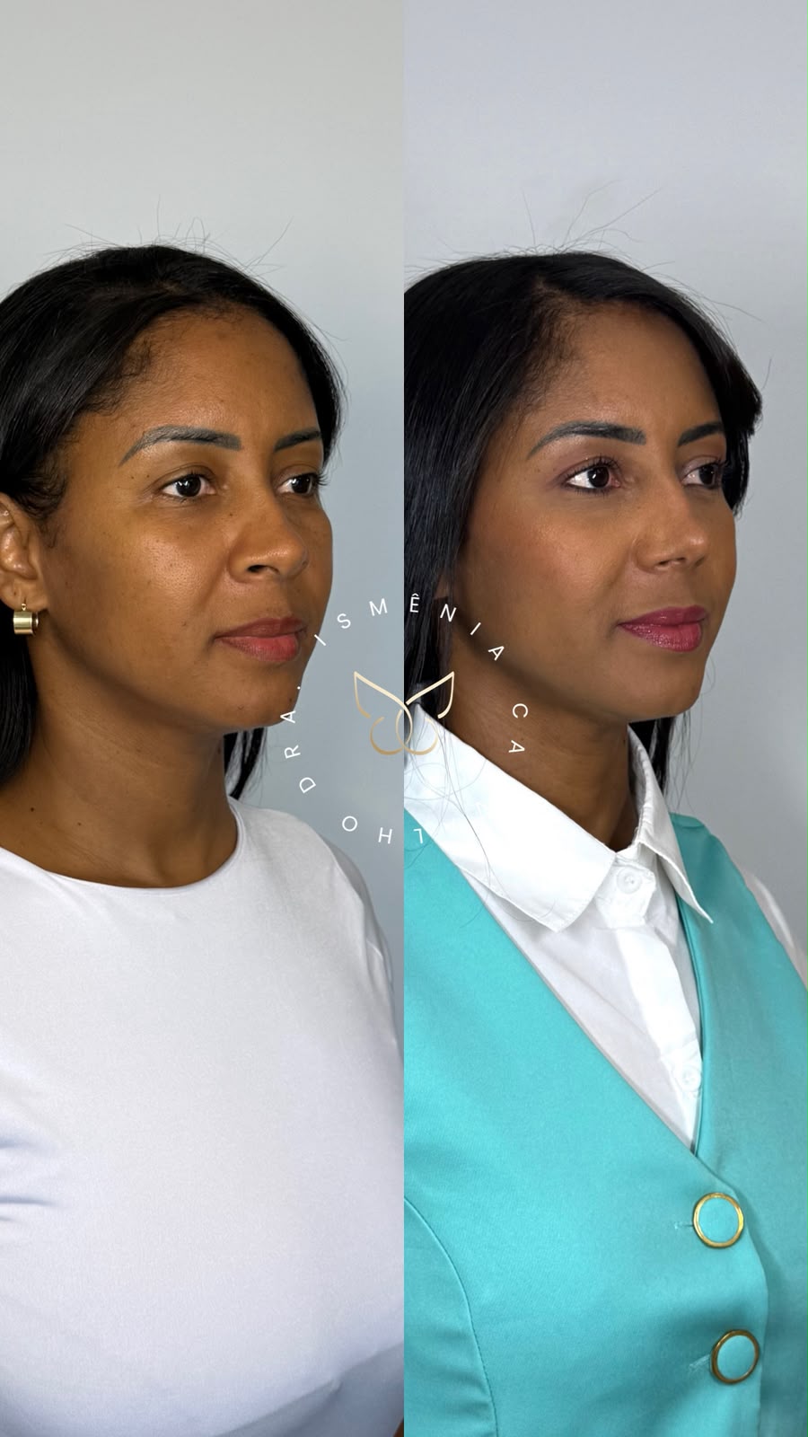 Antes e depois de Rino Sculpt