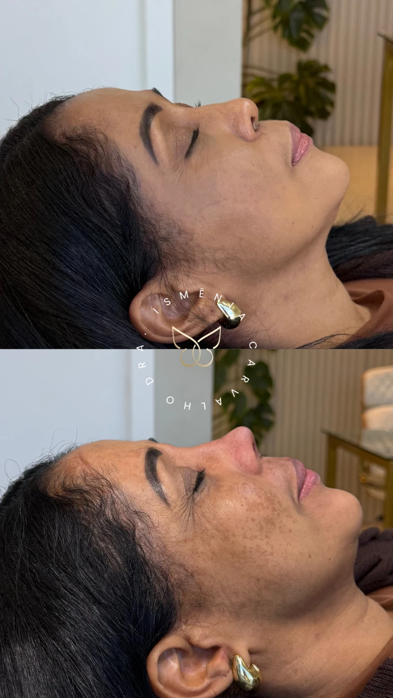 Antes e depois de Rino Sculpt
