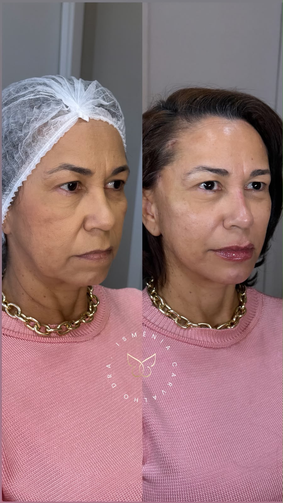 Antes e depois de Lift Sculpt