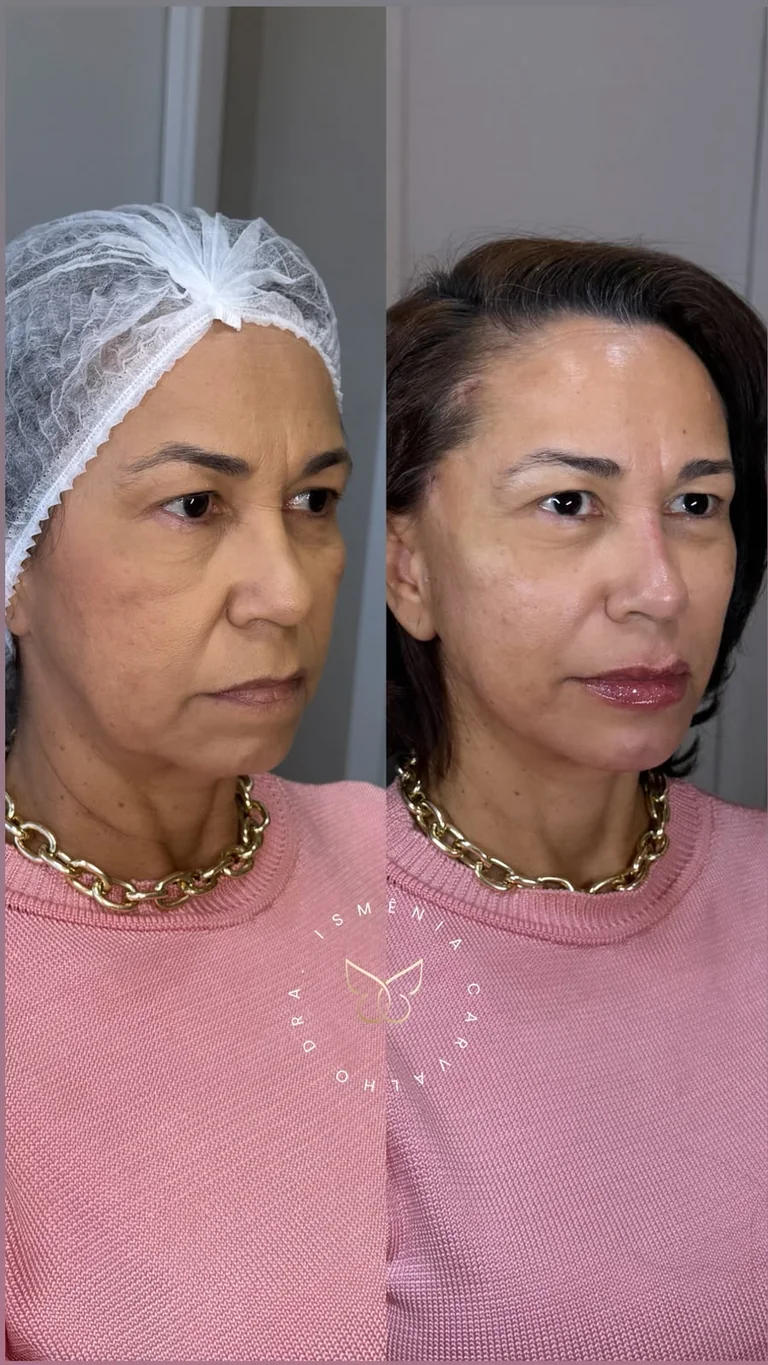 Antes e depois de Lift Sculpt