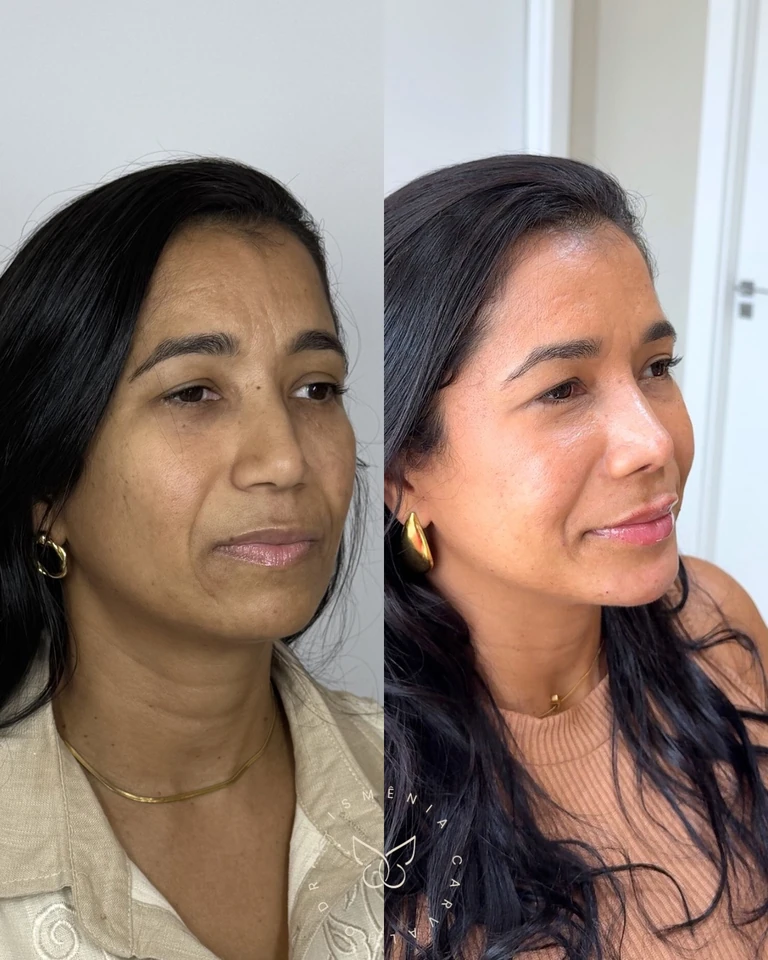 Antes e depois de Face Sculpt